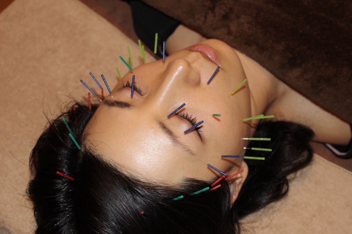 美容鍼の施術の流れ７：お顔への鍼の様子